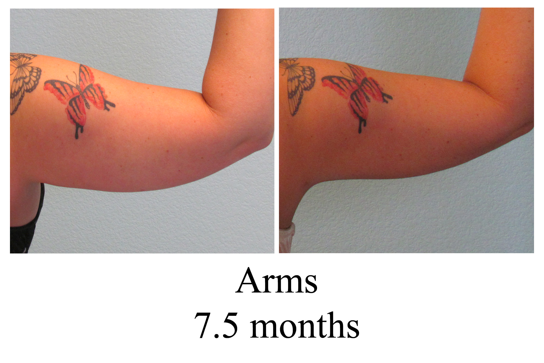 B-A Arms from back AM 7.5 mo