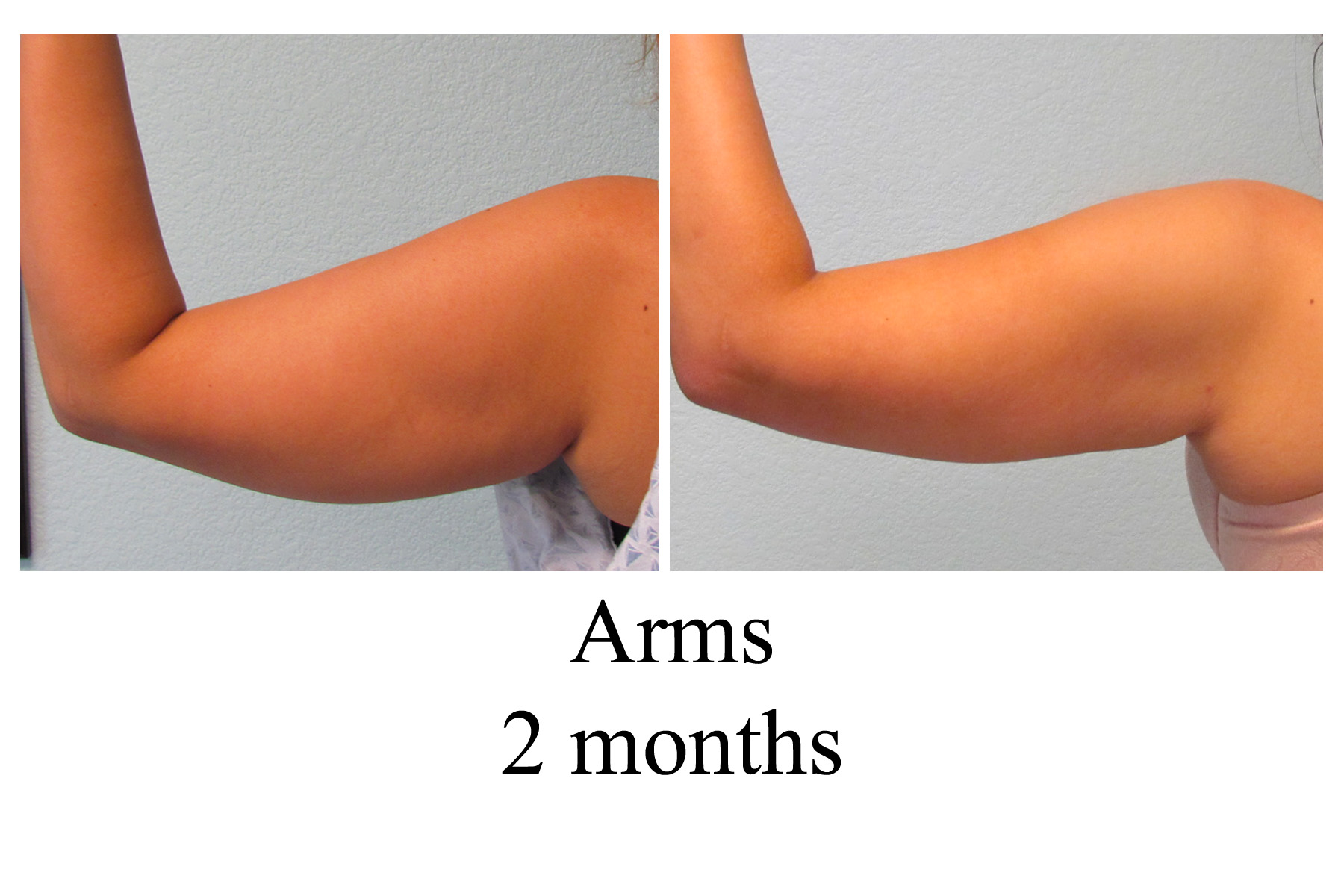 B-A Arms from back BM 2 mo