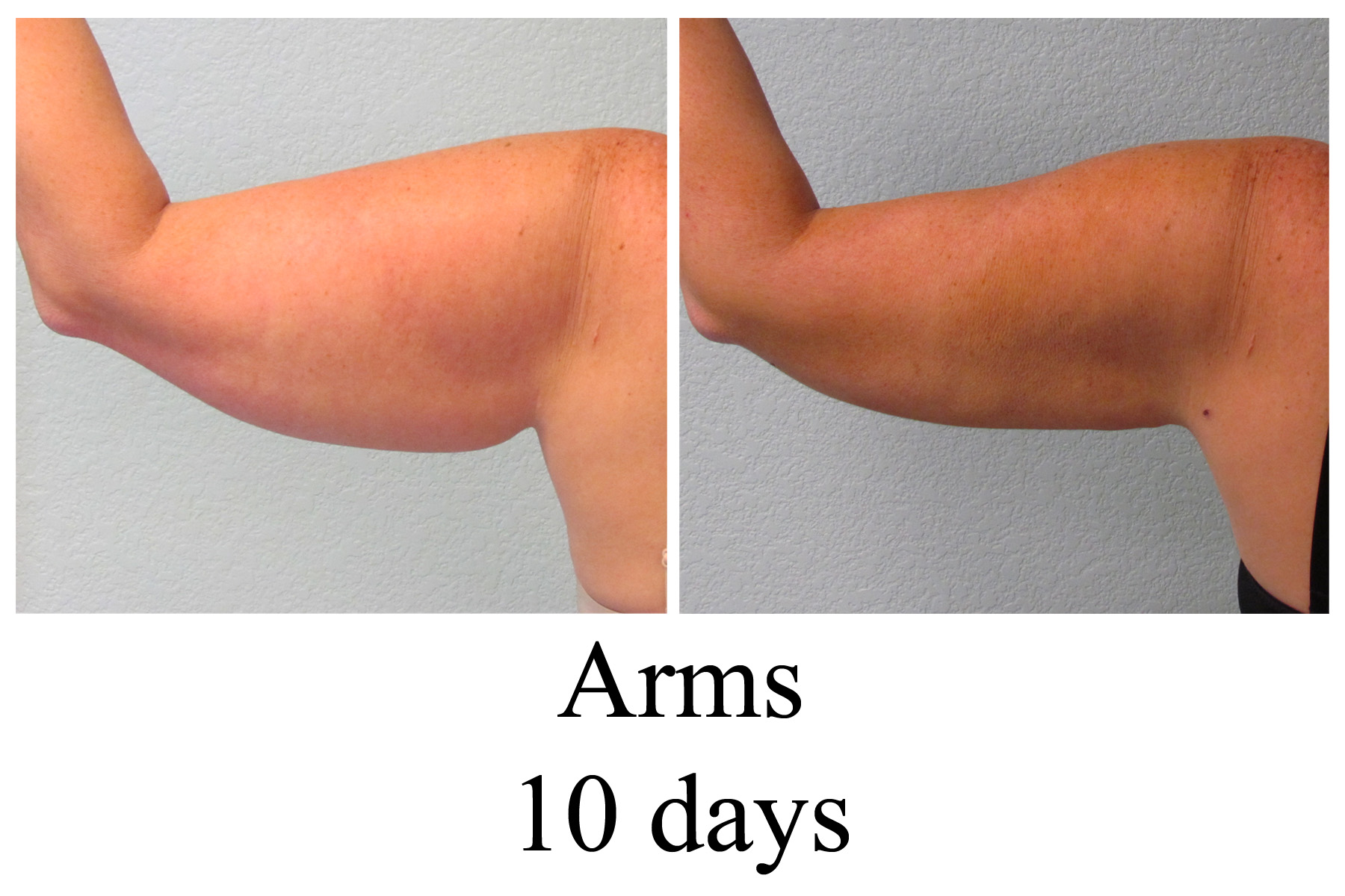 B-A Arms from back MP 10 days