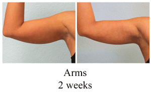 B-A-Arms-from-front-NR-2wks