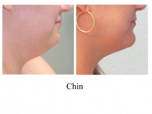 B-A CHin from rt side TJ