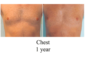 B-A-Chest-from-from-front-JS-1-year