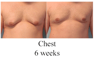 B-A-Chest-from-front-JD-6-wks