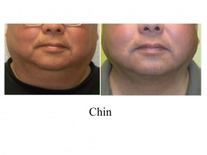 B-A Chin from front EW