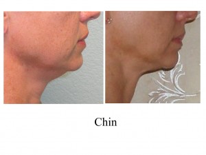 B-A Chin from side AC