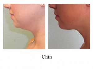 B-A Chin from side AK