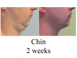 B-A Chin from side BR