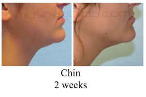 B-A-Chin-from-side-NG-2-wks