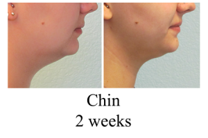 B-A-Chin-from-side-RF-2wks