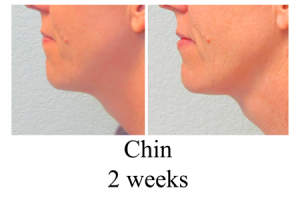 B-A-Chin-from-side-SM-2-wks