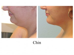 B-A Chin from side TJ