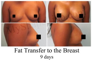 Fat Transfer to Breasts