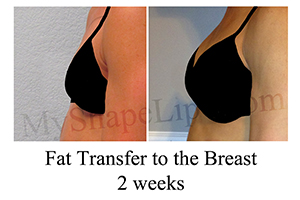 Fat Transfer to Breasts