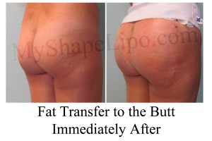 B-A FT butt LC right after cr