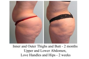 B-A IO thi, Butt, UL abd, Lh, Hips from side DS 2 mo