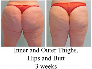 B-A IO thi, Hips, Butt from back DS 3 weeks