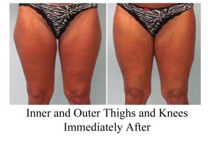 B-A IO thi, Knees from front CM right after