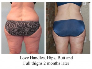 B-A LH, HIps, Butt, Full thi from back CT 2 mo high res