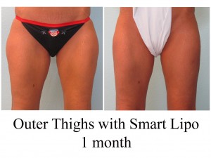 B-A O thi with SL from front BL 1 months