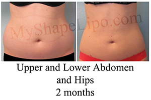 B-A UL abd, Hips from front BL 2 months cr