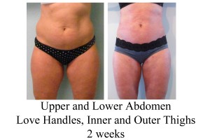 B-A UL abd, LH, IO thi from front CV 2 wks