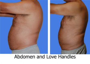 abdomen-liposuction-love-handles-chest-127