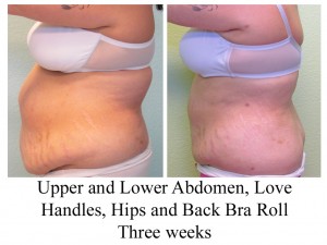 b-a-ul-abd-lh-hips-bbr-from-side-hb-high-res
