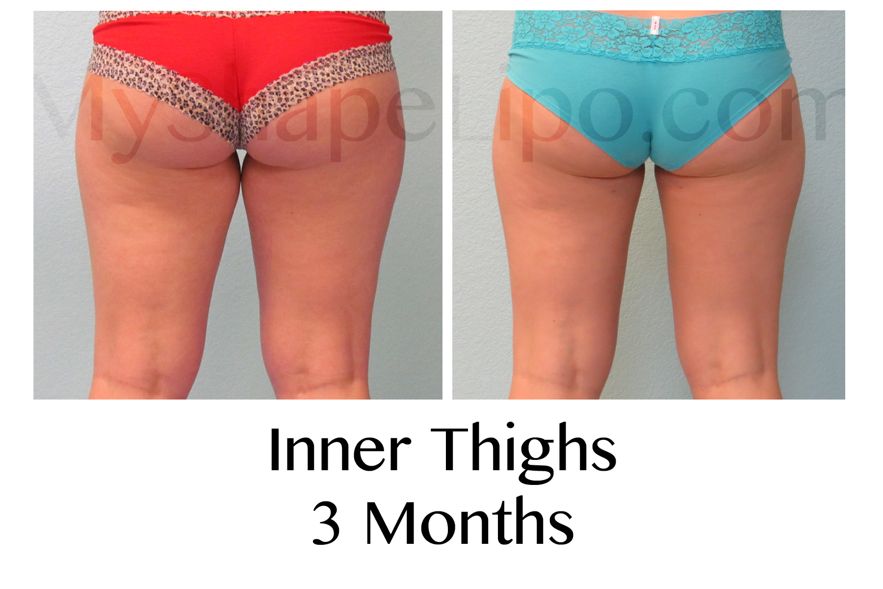 liposuction on thighs