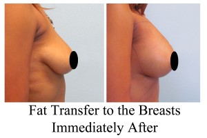 fat transfer to breasts, natural breast augmentation, breast augmentation, boob job, breast implants