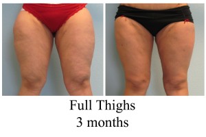 B-A Full Thighs from front GH 3 mo