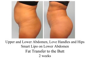 B-A UL abd, LH, Hips, FT Butt from side SM 2 wks