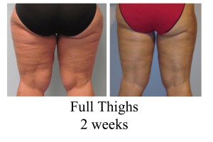 B-A full thighs from back KB 2 wks