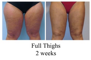 B-A full thighs from front KB 2 wks