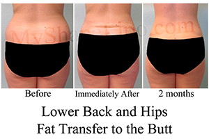 B-A LB, Hips, FT Butt from back BL 2 months cr no black outs