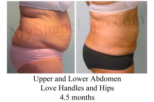 Large Volume Lipo