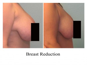 liposuction breast reduction, breast reduction, liposuction breasts, breast augmentation