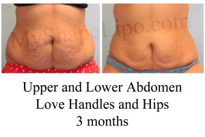 B-A UL abd, LH, Hips from front NG 3 mo cr