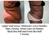  - B-A-UL-abd-LH-Hips-Pannus-SL-Pannus-FBR-BBR-from-side-JH-7-wks-cr-copy