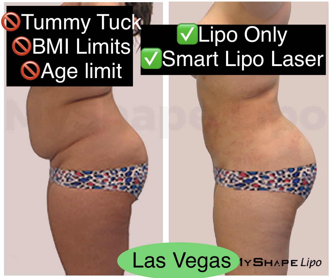 Lipo Is Transformative In Gaining Self Confidence Liposuction