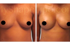 B-A-CEN-ONLY-PHOTOS-FT-BREASTS-from-front-AW-9-days-cr1