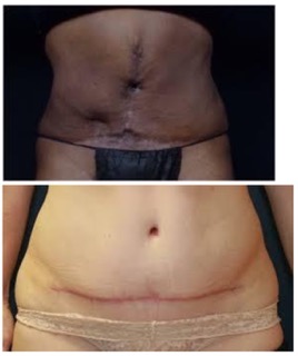 The Dark Side Of The Tummy Tuck